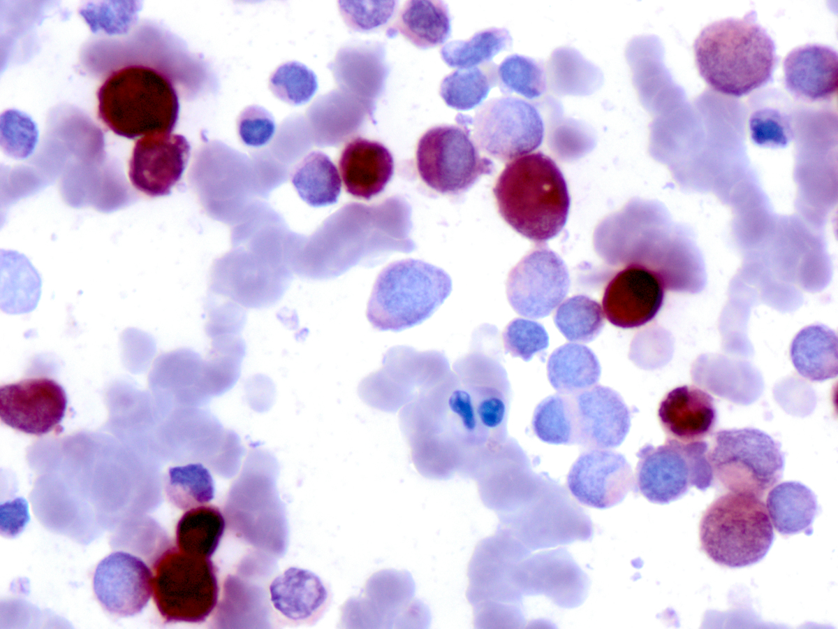 Specimen 1, BM aspirate smear, non-specific esterase x 500